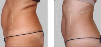 Cryolipolyse femme avant et après Cryolipolyse femme avant et après